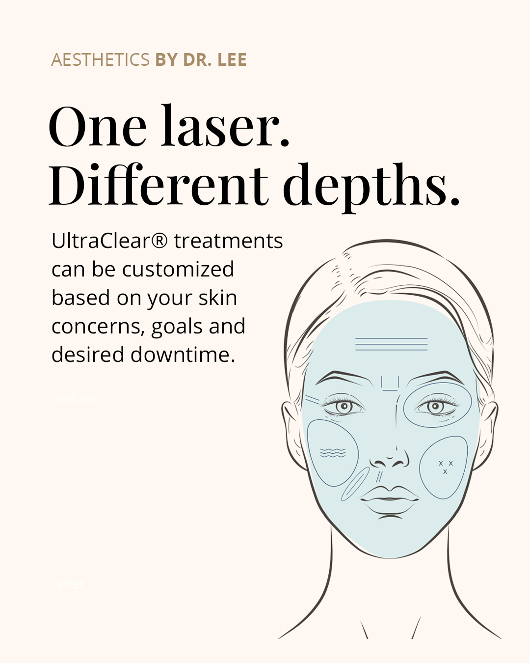 UltraClear laser treatment image 4