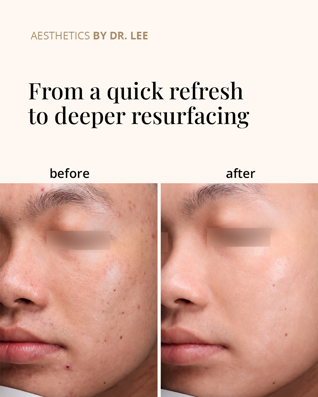 Physician-supervised UltraClear laser treatment